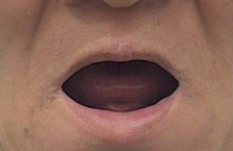 이천 임플란트 치과, 불편한 틀니 때문에 임플란트를 고민하고 있다면? 대표 이미지