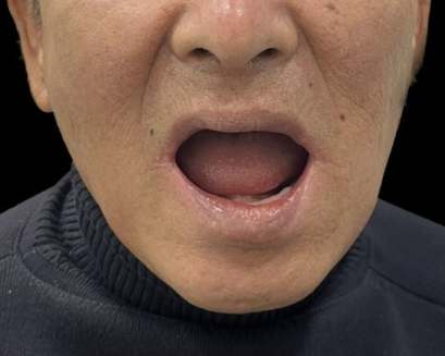 여주 임플란트 치과, 치아가 없어서 오랜 기간 틀니를 사용했던 환자 후기 대표 이미지