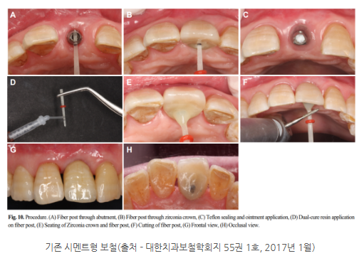 이천 임플란트, 서울이엘치과 시멘트리스 스크류 어버트먼트 ‘우루덴트 SA’ 도입 대표 이미지