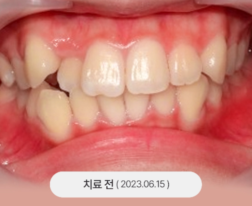 치아교정 치료 전 사진