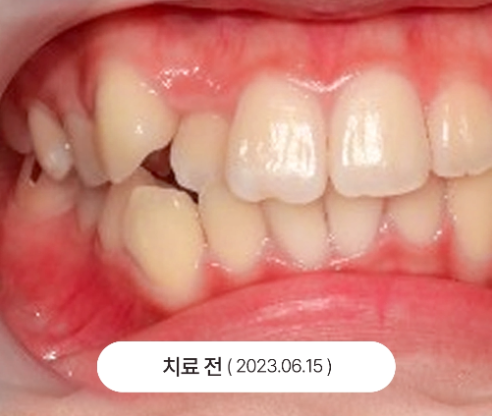 이천치아교정, 반대교합도 투명교정으로 가능할까? 대표 이미지