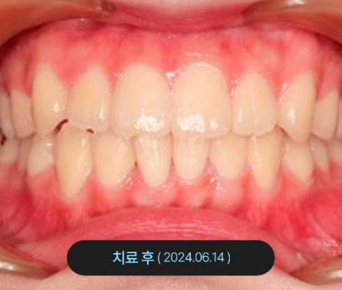 치아교정 치료 후 사진