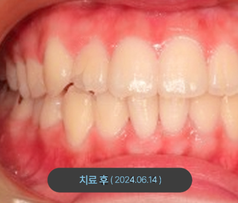 치아교정 치료 후 사진