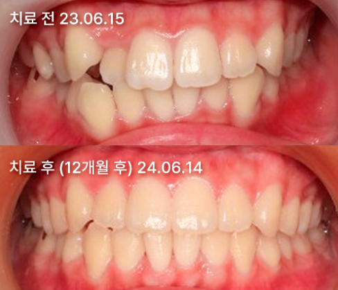 치아교정 치료 전, 후 사진