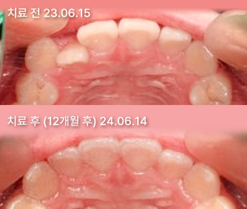 치아교정 치료 전, 후 사진