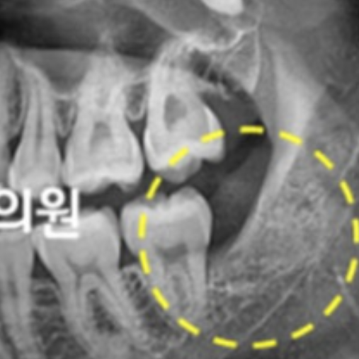 사랑니 발치 부위 발치 후 2개월 경과 비교 구강 내 촬영 자료