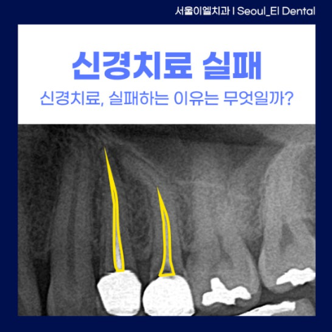 신경치료가 실패하는 원인 사진