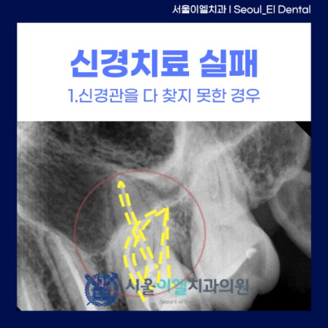 신경관을 다 찾지 못한 경우 예시 사진