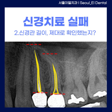 신경관 길이를 제대로 체크하지 못한 경우 사진