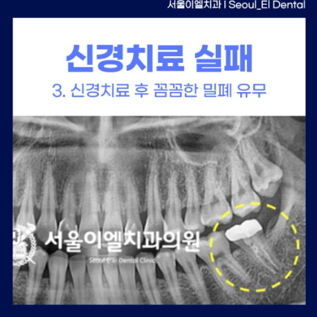 신경치료 후 밀폐가 제대로 되지 않은 경우 사진