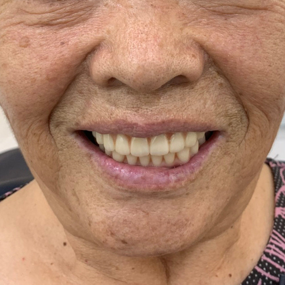 50대 환자분의 무치악 임플란트 치료 후 결과