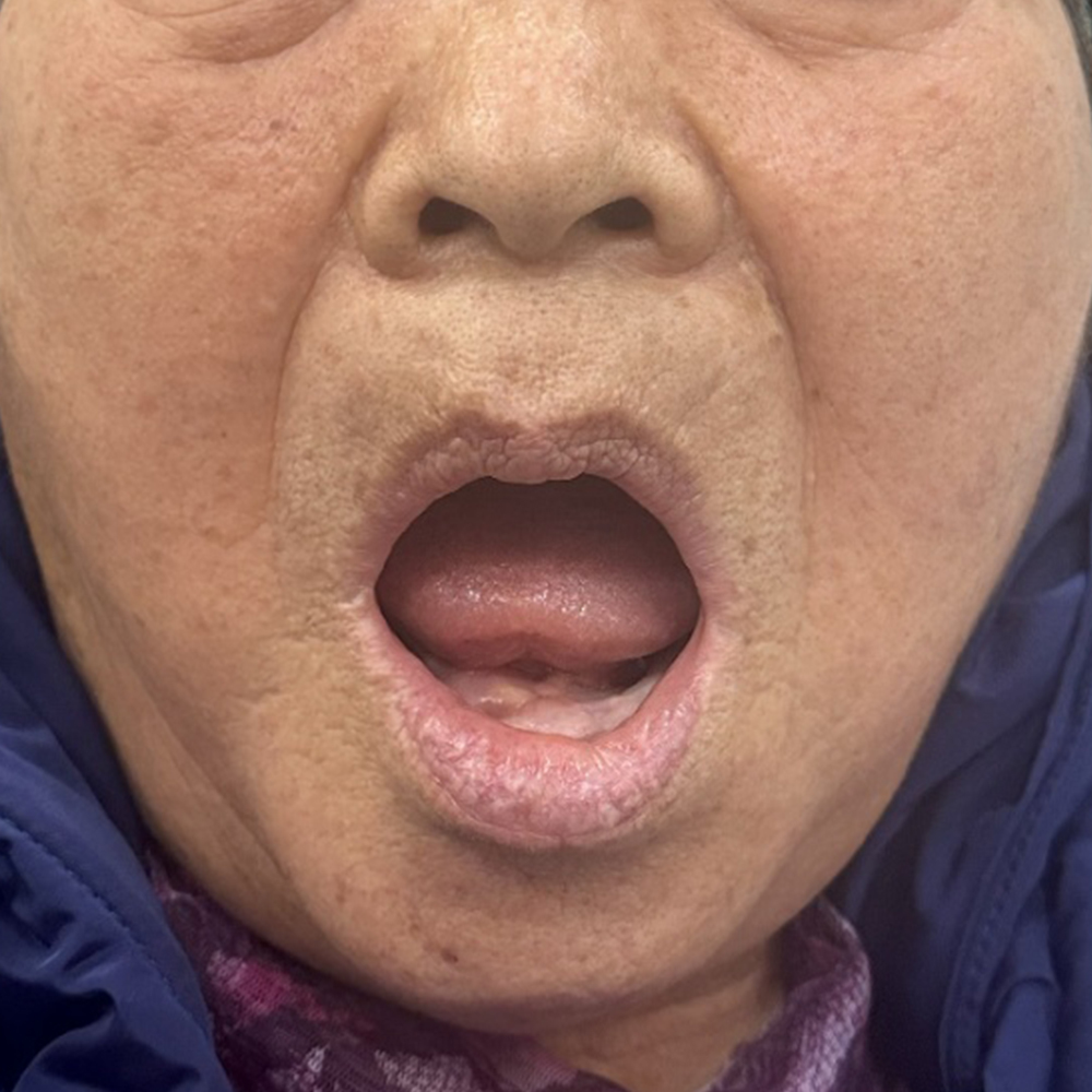 디지털 풀아치 임플란트 상·하악 무치악 치료 전 구강 자료