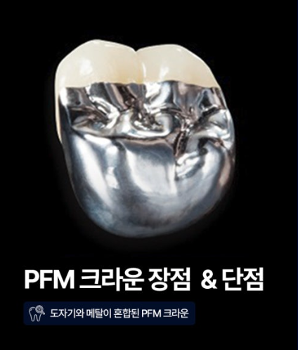 치아 크라운 종류별 장단점, 골드·지르코니아·PFM 어떻게 다를까요? 대표 이미지
