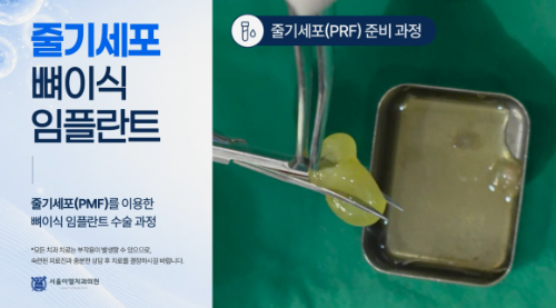 줄기세포 뼈이식 임플란트 PRF 준비 과정 사진