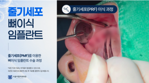 킹스템 자가혈 재생시술, 이천 서울이엘치과 도입 소식 대표 이미지