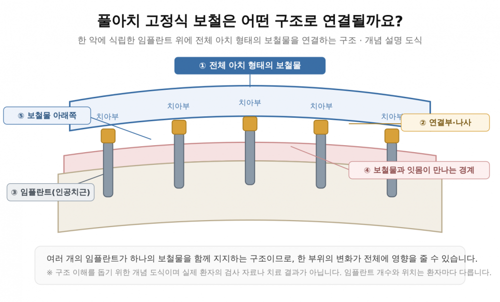 풀아치 임플란트 고정식 보철의 구조를 설명하는 개념 도식. 임플란트, 연결부와 나사, 전체 아치 보철물, 잇몸 경계와 보철물 아래쪽 표시