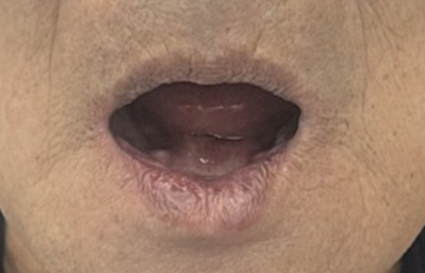 무치악 임플란트, 틀니를 더 쓰기 어려웠던 50대 환자의 치료 후기 대표 이미지