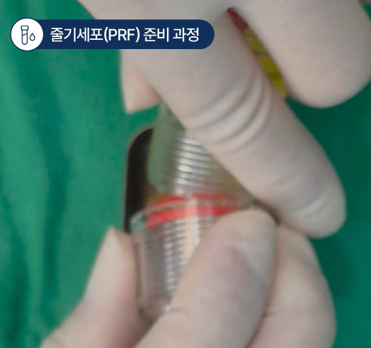 킹스템 뼈이식 임플란트 잇몸뼈 이식 부위 적용 전 자가혈 채혈 및 원심분리 성분 준비 자료