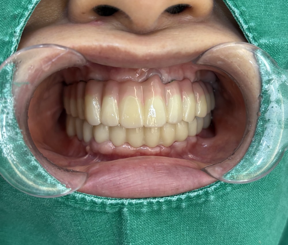 풀아치 임플란트 상악 하악 전체 연결형 보철물 장착 후 구강 정면 촬영 자료