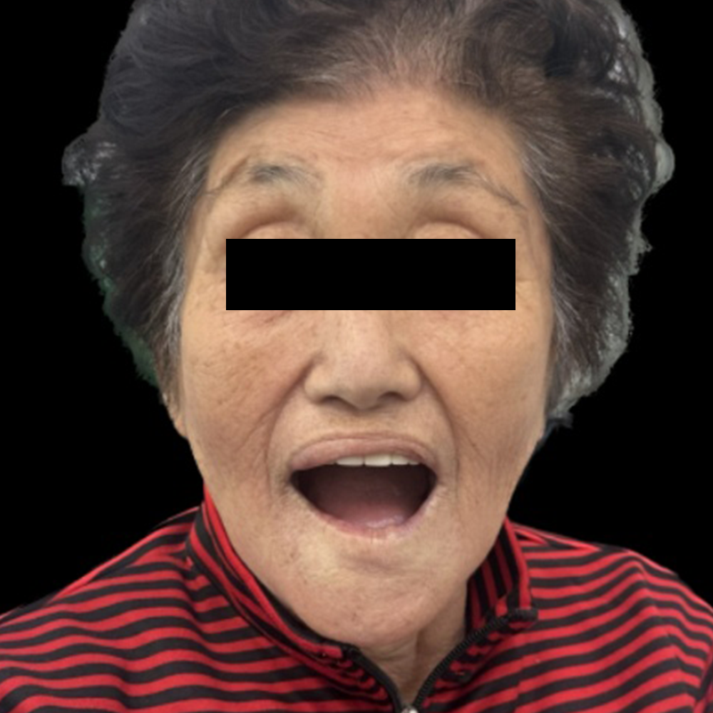 풀아치 임플란트 치료 전 사진