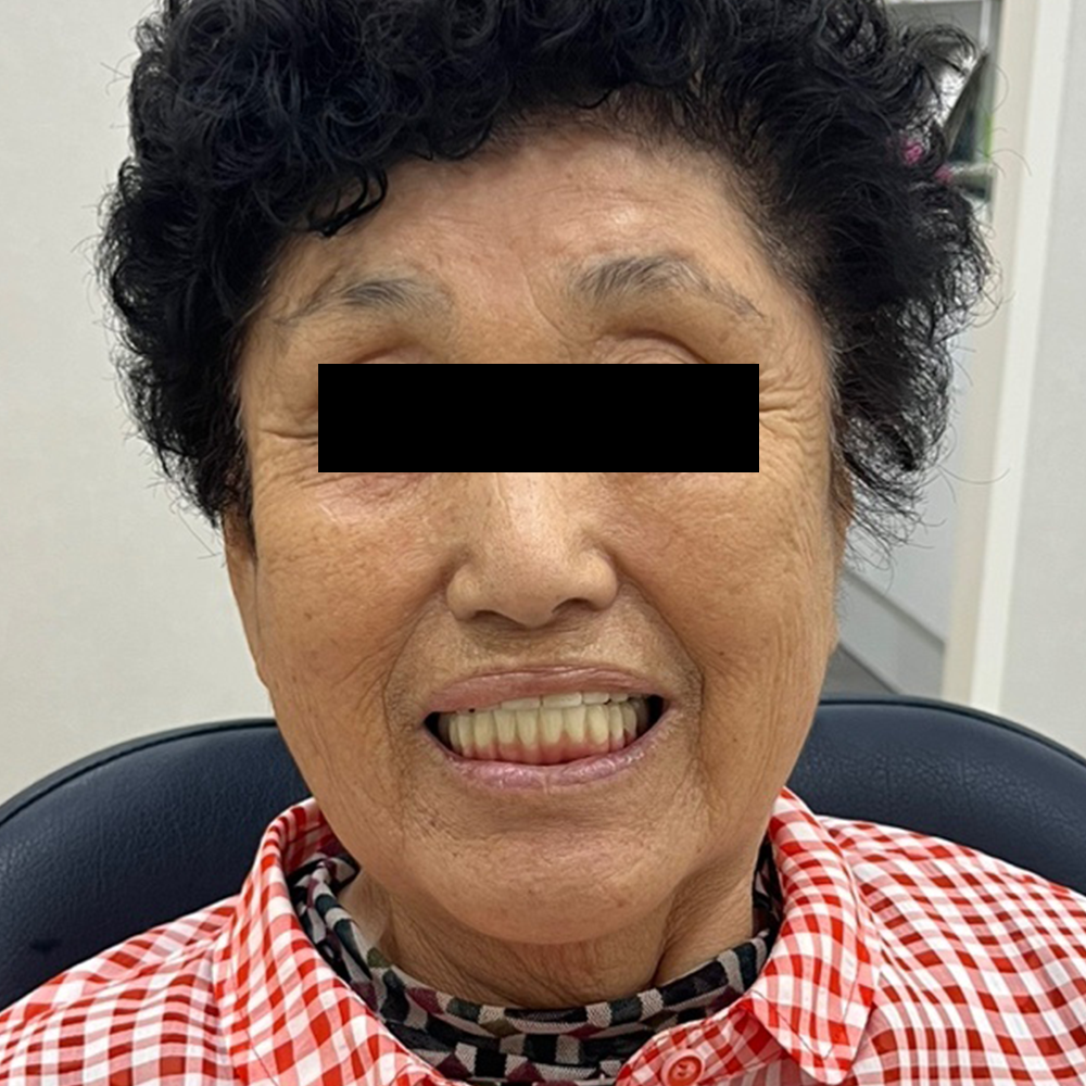 하악 풀아치 임플란트 아래턱 최종 보철 장착 후 구강 내 촬영 자료