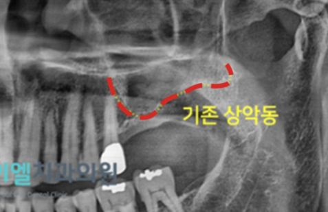 상악동 위치와 위쪽 어금니 부위 잇몸뼈를 표시한 설명 그림