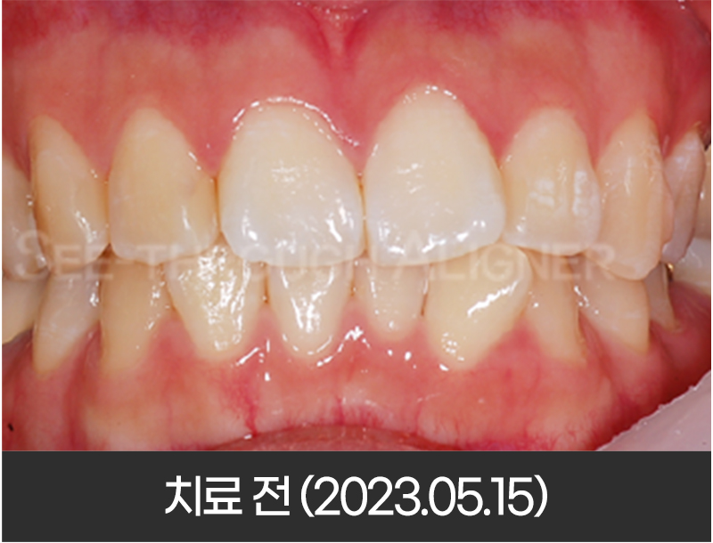 디지털 치아교정 치료 전 구강 내 정면 사진(2023년 5월 촬영)