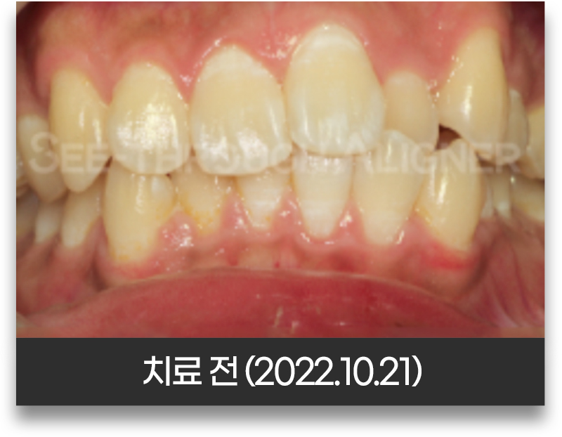 반대교합 교정 전 정면 구강 사진(2022년 10월 21일, 아래 앞니가 위 앞니보다 앞에서 물린 상태)
