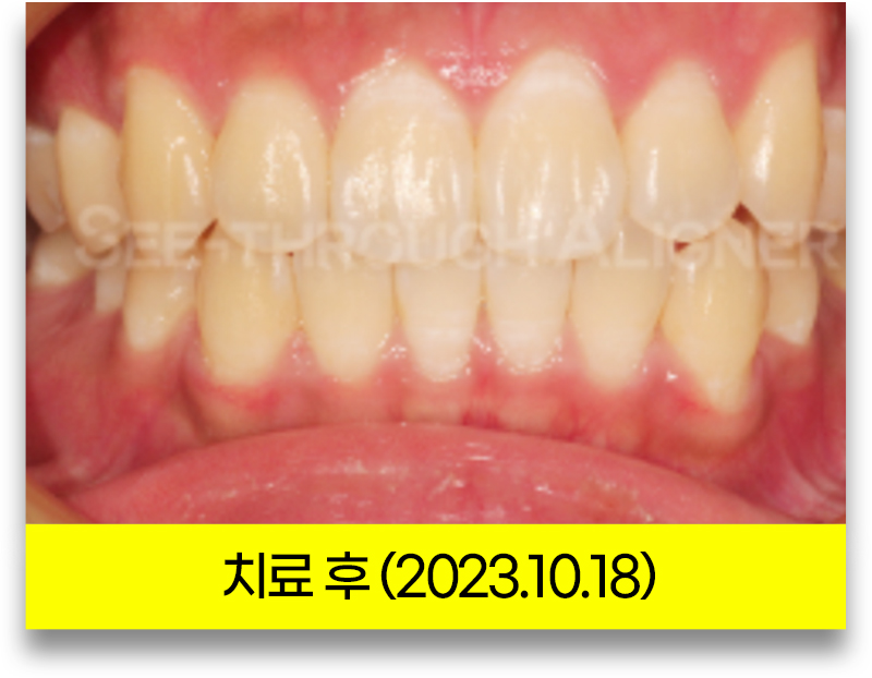반대교합 교정 후 정면 구강 사진(2023년 10월 18일, 위 앞니가 아래 앞니를 덮도록 맞물린 상태)