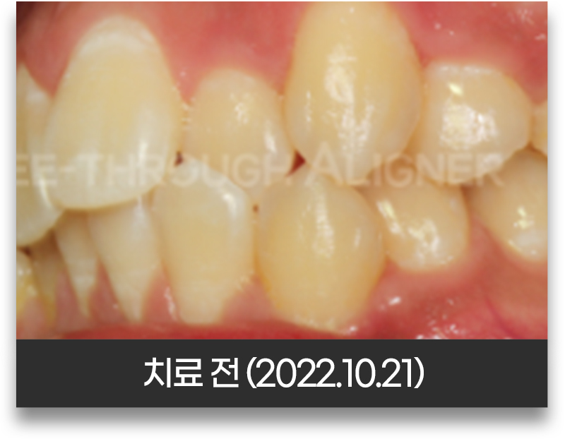 반대교합 교정 전 측면 구강 사진(2022년 10월 21일, 반대로 물린 앞니 부위)