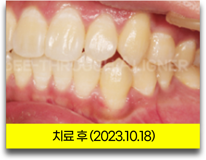 반대교합 교정 후 측면 구강 사진(2023년 10월 18일, 위 앞니가 아래 앞니를 덮도록 맞물린 앞니 부위)