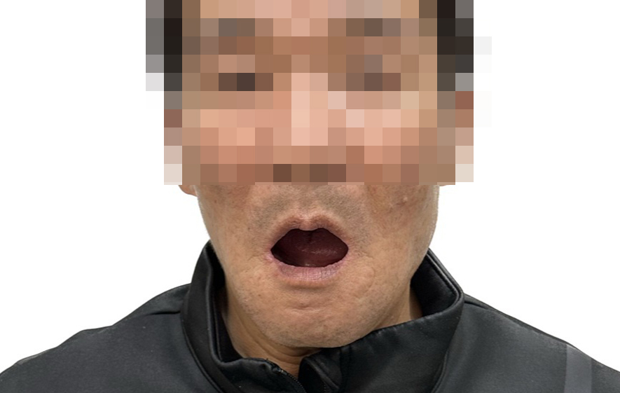 풀아치 임플란트 치료 전 얼굴 사진(입을 벌렸을 때 위아래 치아가 보이지 않는 완전 무치악 상태)