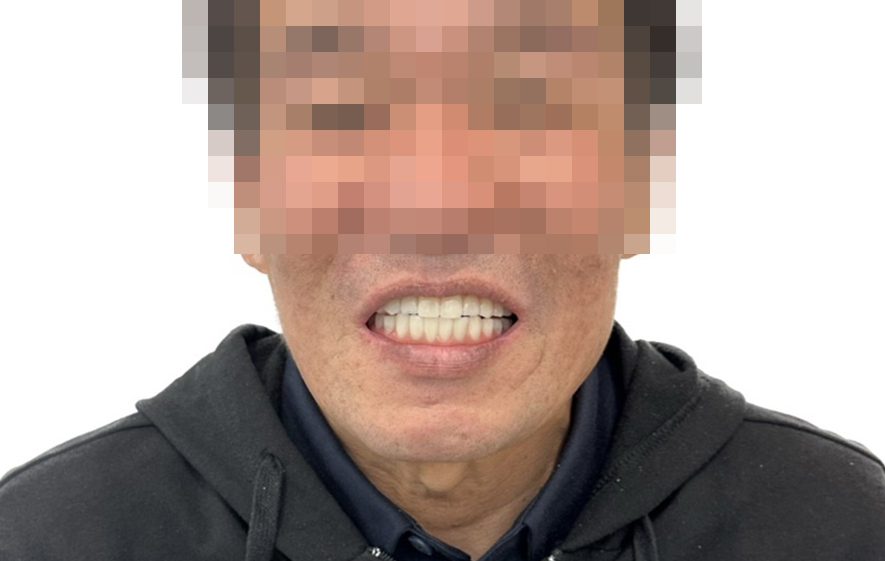 풀아치 임플란트 치료 후 얼굴 사진(상·하악 아치형 보철로 수복한 모습)