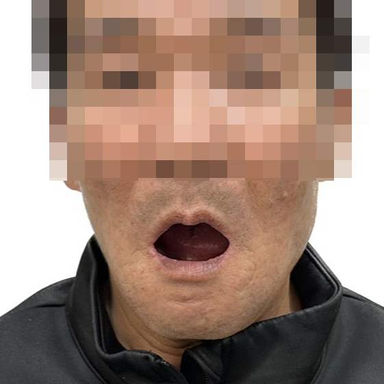 풀아치 임플란트 치료 전 얼굴 사진(입을 벌렸을 때 위아래 치아가 보이지 않는 완전 무치악 상태)
