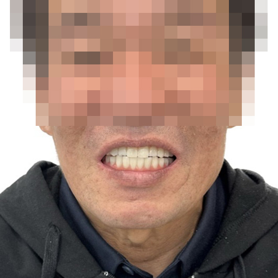 풀아치 임플란트 치료 후 얼굴 사진(상·하악 아치형 보철로 수복한 모습)