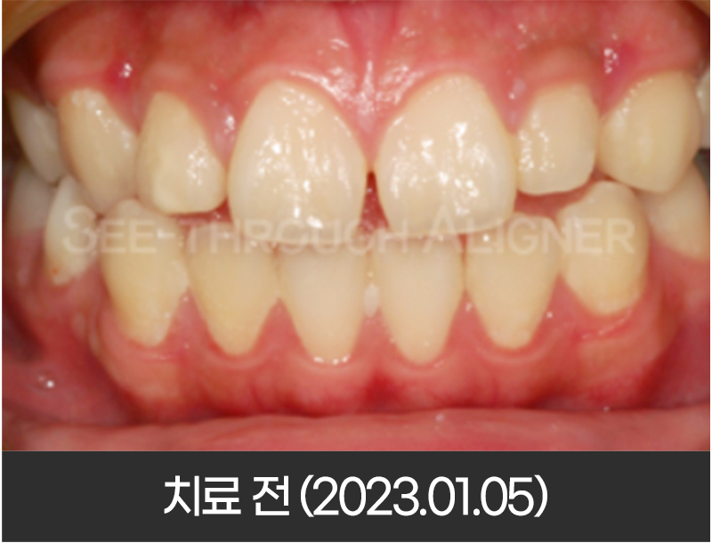 돌출입 교정 전 정면 구강 사진(2023년 1월 5일)