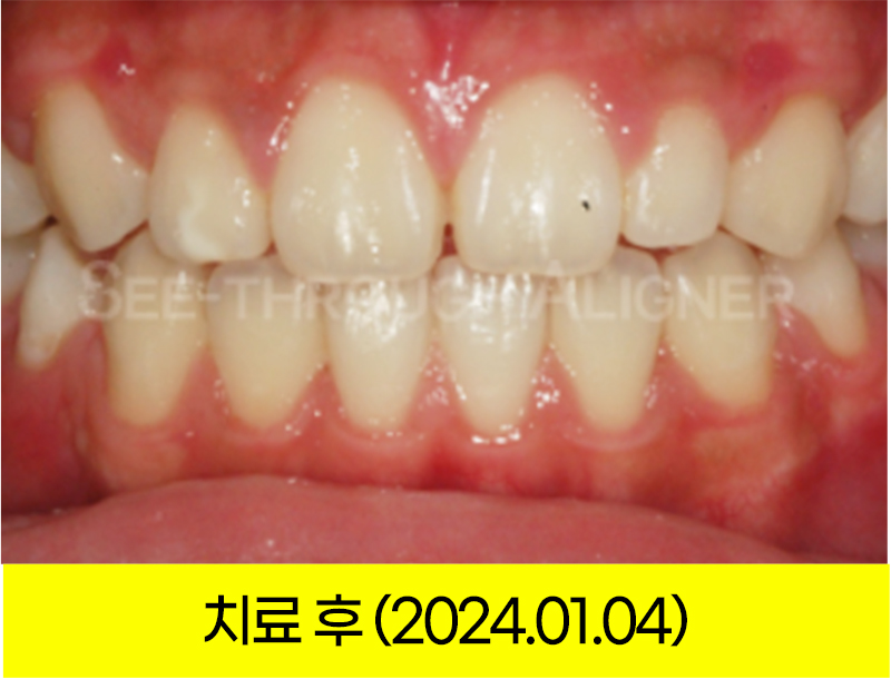 돌출입 교정 후 정면 구강 사진(2024년 1월 4일)