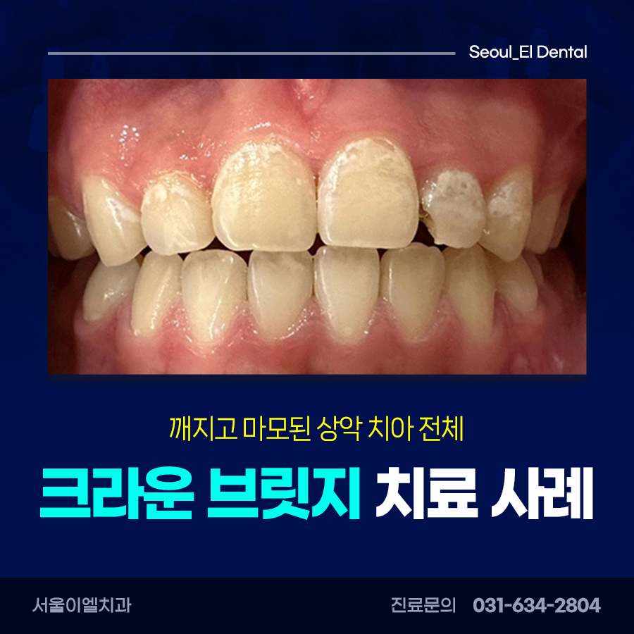 크라운 치료 사례 안내 사진(치료 전 구강 내 사진)
