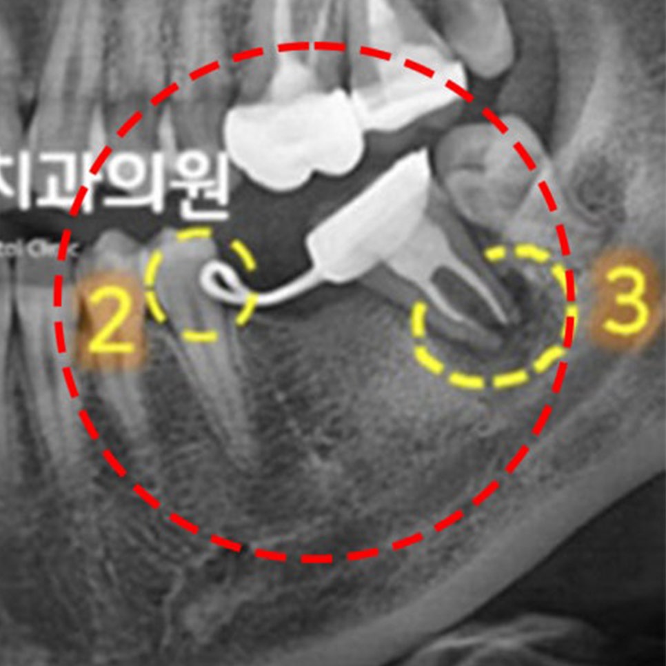 내원 당시 아래 어금니 부위 X-RAY(공간유지장치가 걸린 치아와 뿌리 염증이 있는 치아, 빨간 점선)