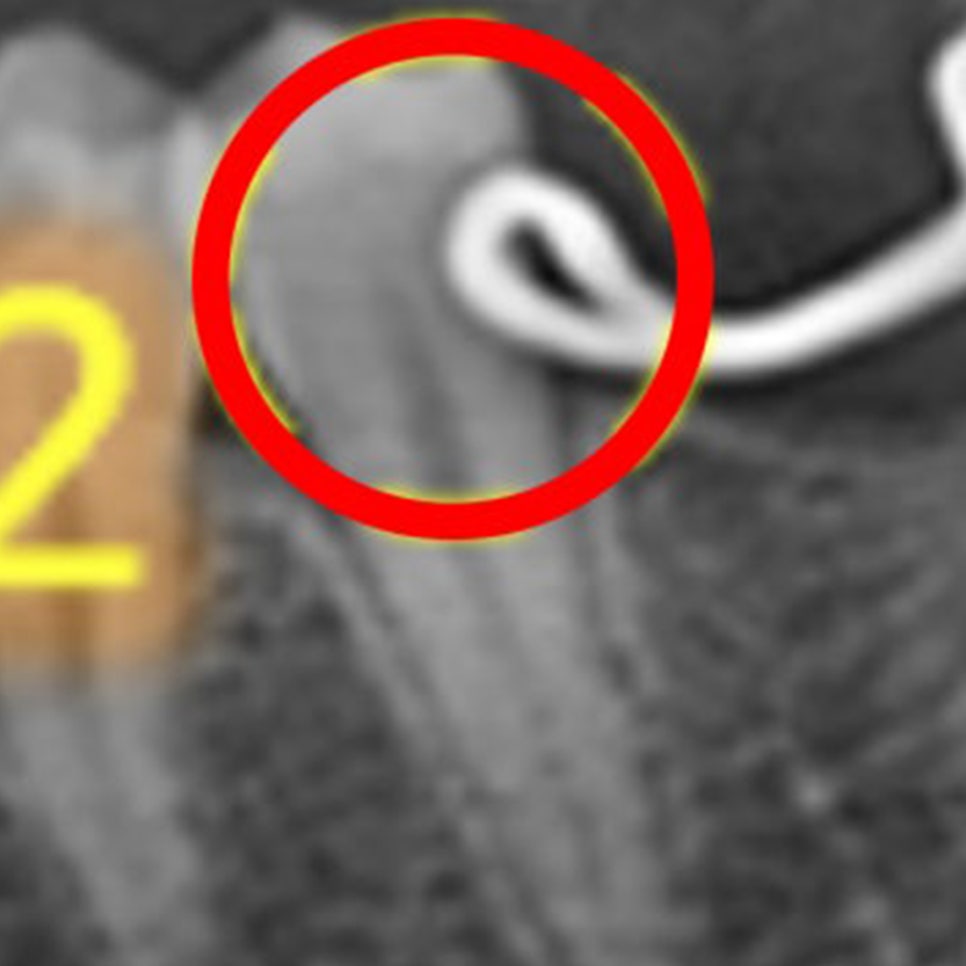공간유지장치 고리와 옆 치아가 맞닿은 부위를 확대한 X-RAY(빨간 원)