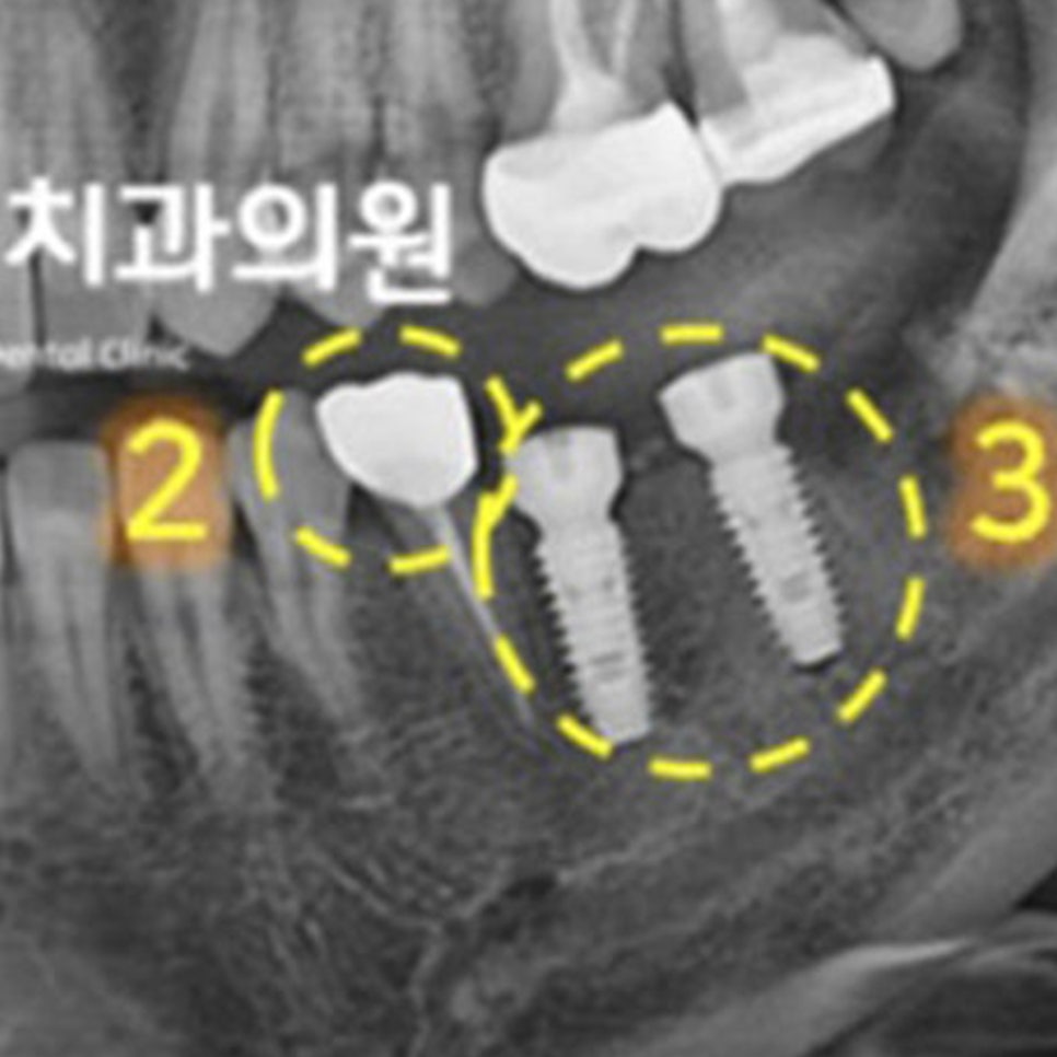 신경치료한 치아에 크라운을 씌우고 임플란트 2개를 식립한 뒤 X-RAY(노란 점선)