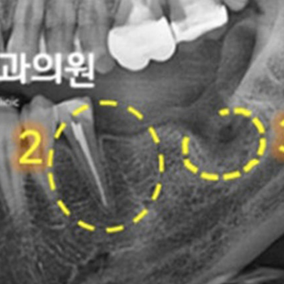 신경치료와 발치를 마친 뒤 촬영한 아래 어금니 부위 X-RAY(신경치료한 치아와 발치한 자리)