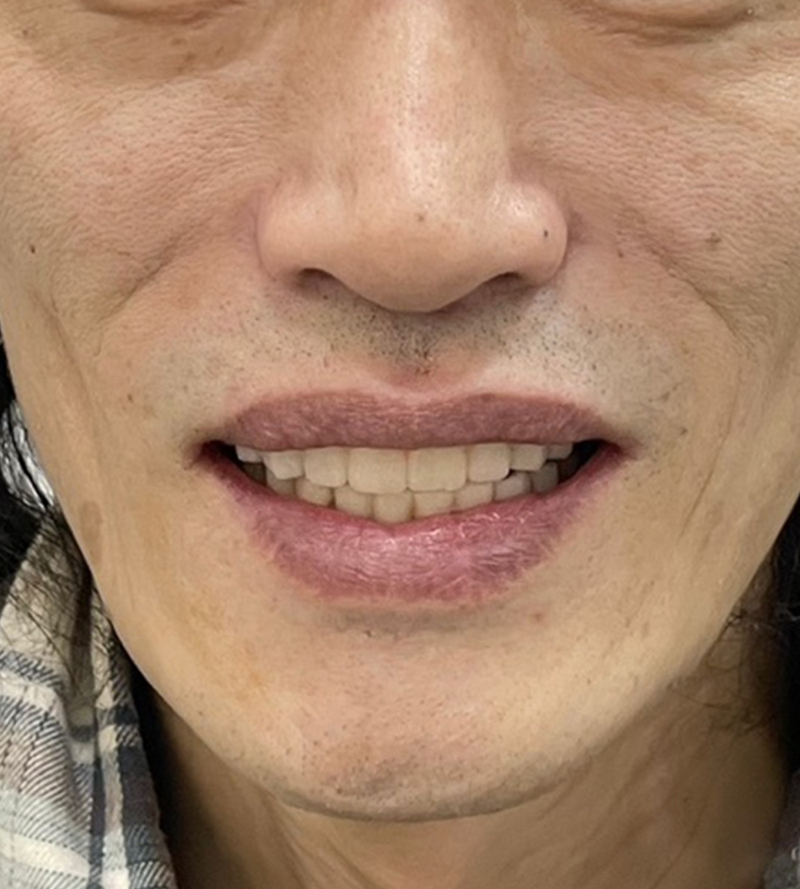 디지털 풀아치 임플란트 시술 후 이미지
