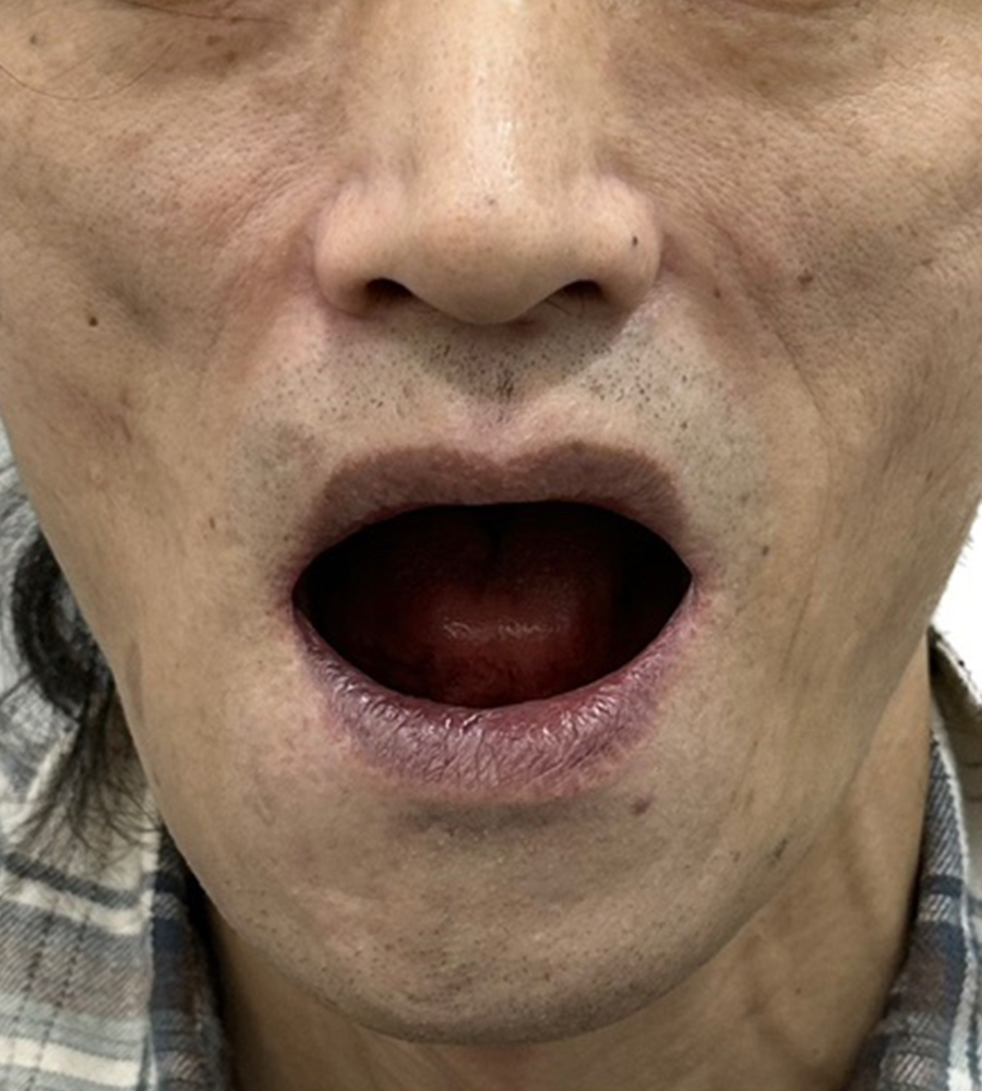 디지털 풀아치 임플란트 시술 전 이미지