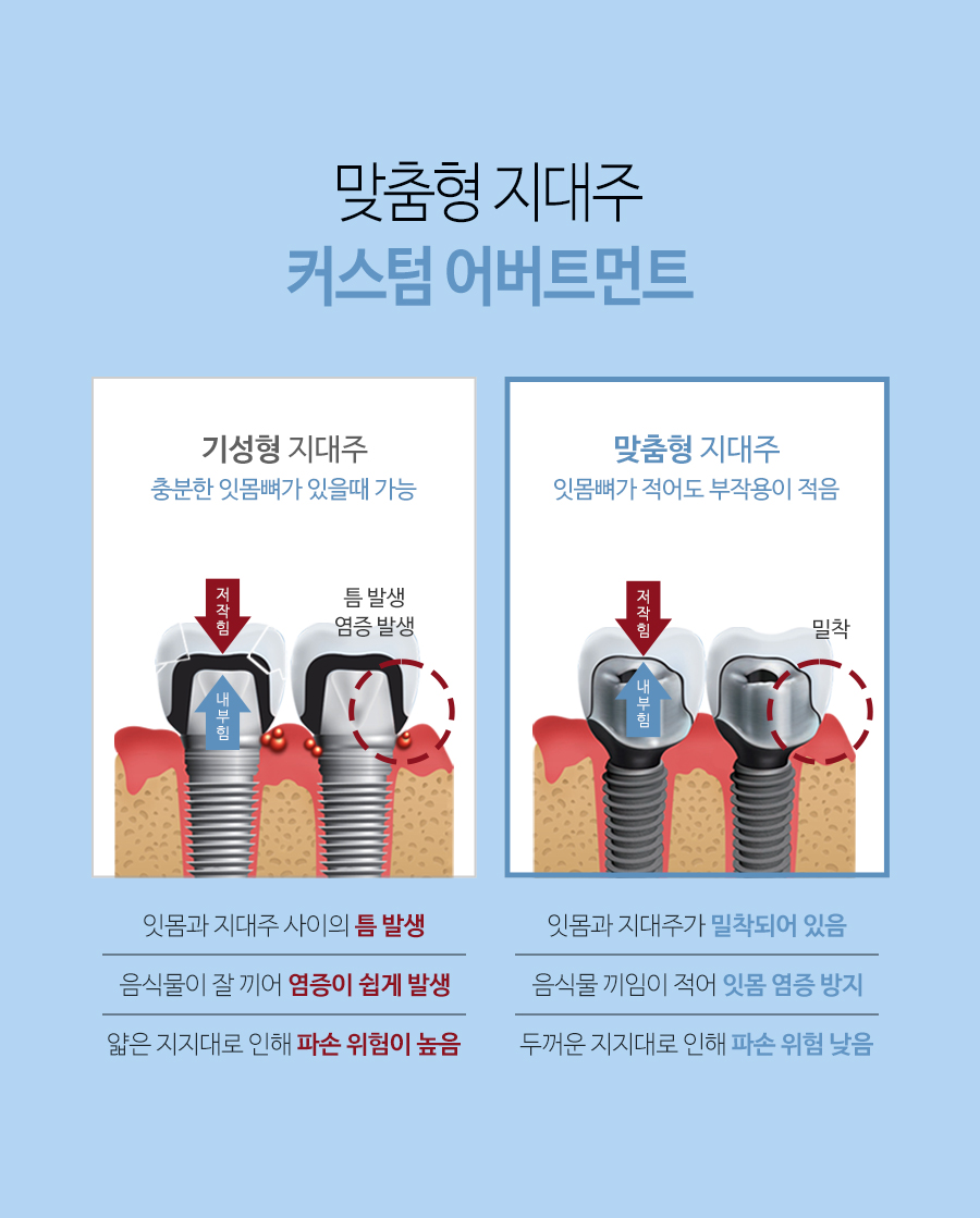 이천 서울이엘치과 디지털 임플란트 안내 이미지 13