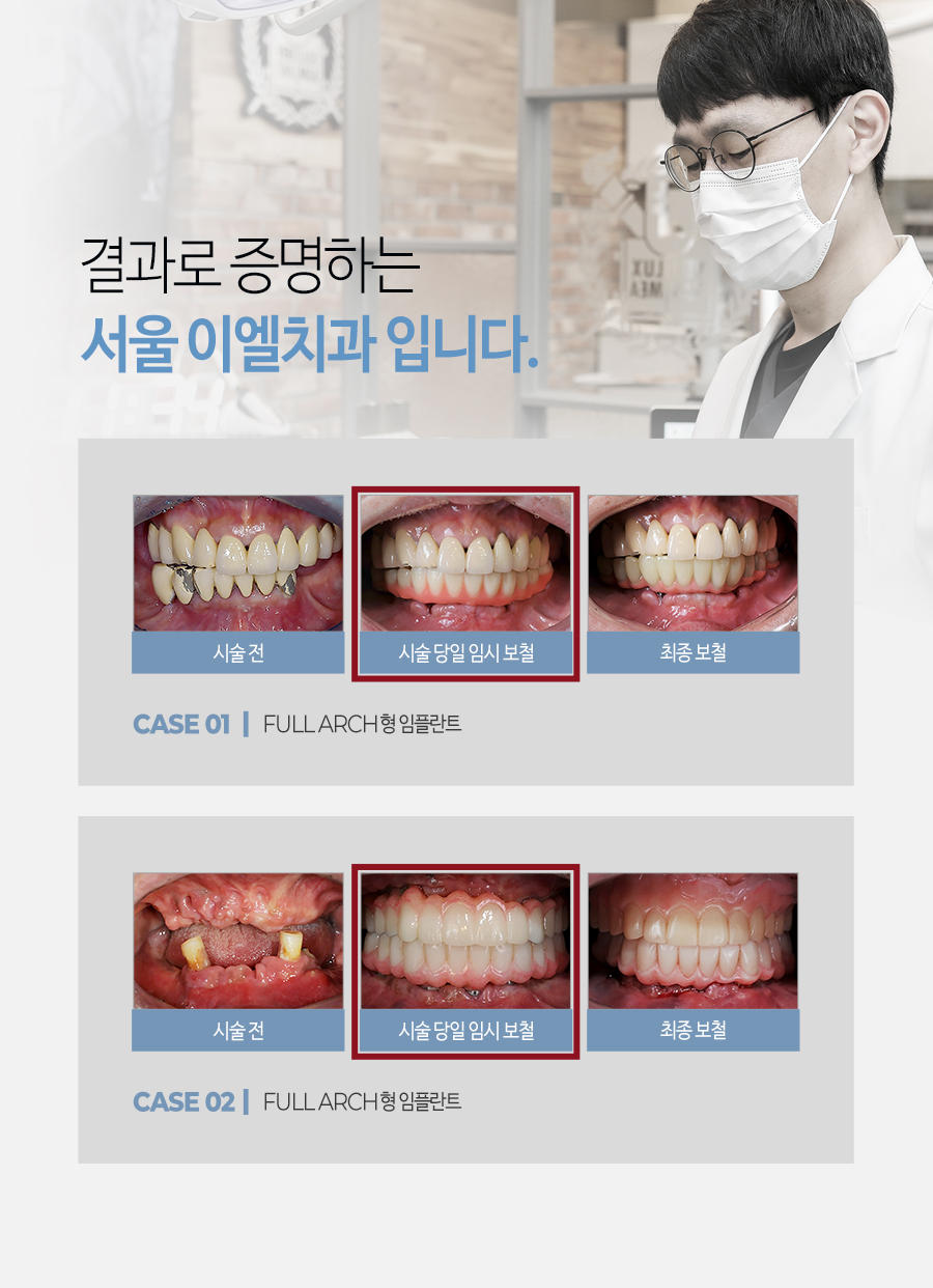 이천 서울이엘치과 디지털 임플란트 안내 이미지 21