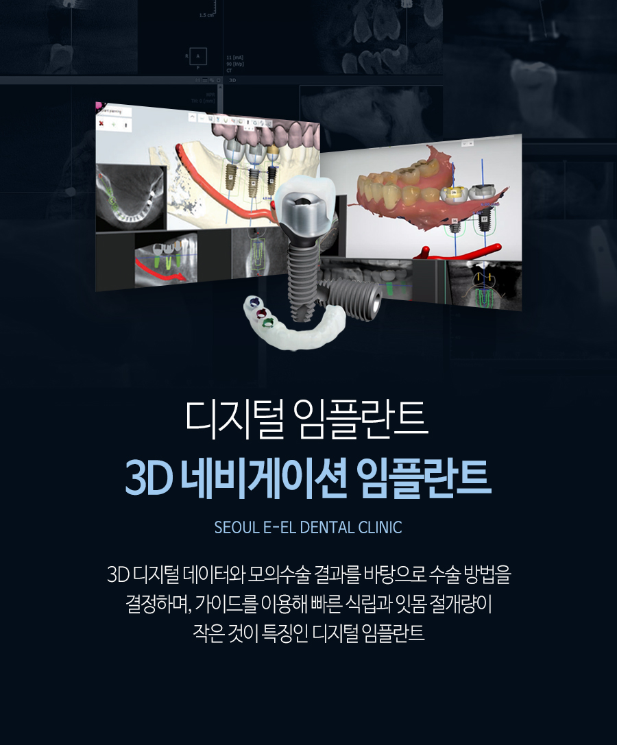 이천 서울이엘치과 디지털 임플란트 안내 이미지 3