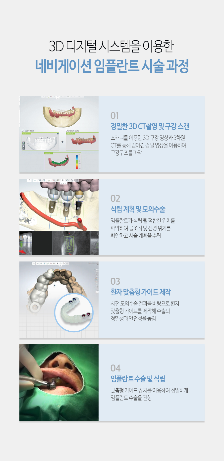 이천 서울이엘치과 디지털 임플란트 안내 이미지 6