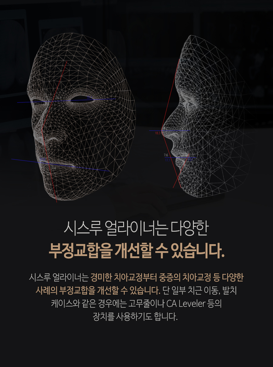 이천 서울이엘치과 디지털 치아교정 안내 이미지 8