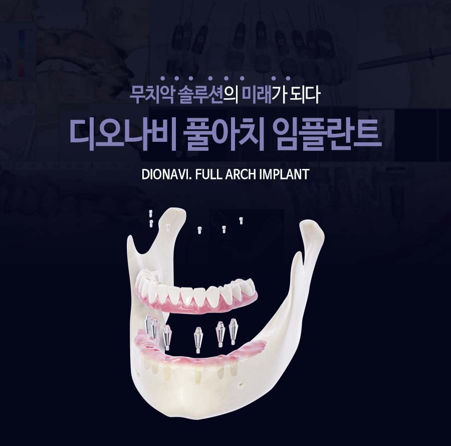 이천 서울이엘치과 풀아치 임플란트 안내 이미지 1